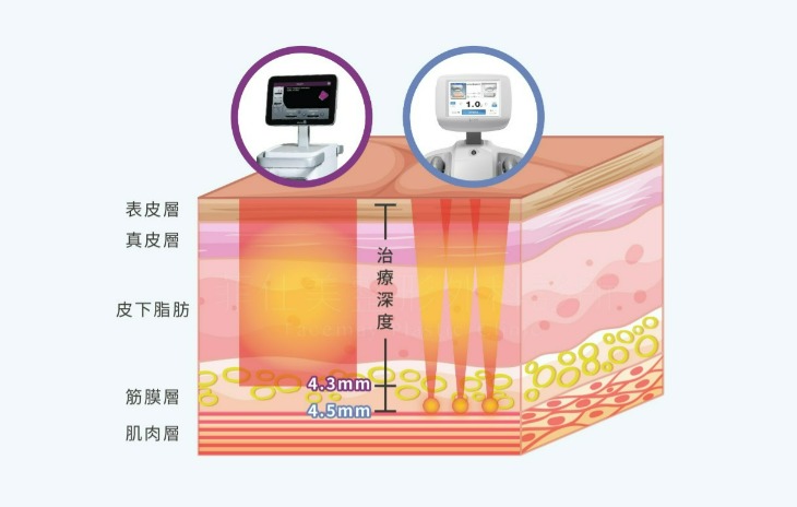 海芙音波拉提2022重點整理，多久打一次海芙音波拉提費用多少合理