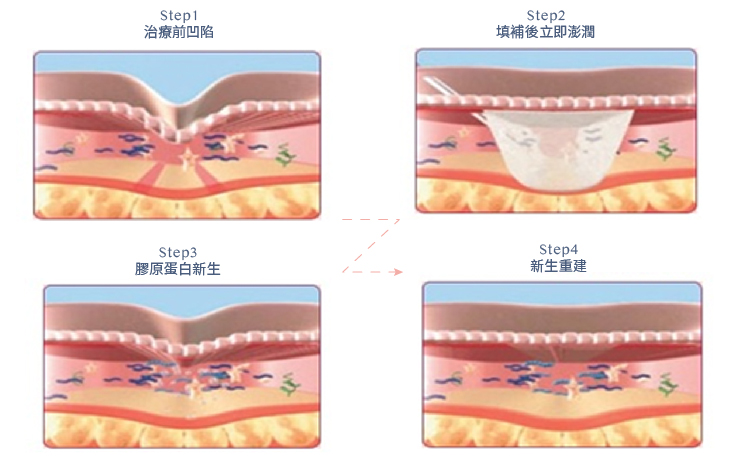 Sculptra舒顏萃主要成分為100%聚左旋乳酸(PLLA),聚左旋乳酸是一種微粒粉末,與人體相容高、可吸收、可代謝,是十分安全的物質。聚左旋乳酸進入體內後,會吸引自身的纖維母細胞靠近,並刺激纖維母細胞產生膠原蛋白,使肌膚恢復其豐潤、彈性-02 Sculptra舒顏萃主要成分為100%聚左旋乳酸(PLLA),聚左旋乳酸是一種微粒粉末,與人體相容高、可吸收、可代謝,是十分安全的物質。聚左旋乳酸進入體內後,會吸引自身的纖維母細胞靠近,並刺激纖維母細胞產生膠原蛋白,使肌膚恢復其豐潤、彈性-02