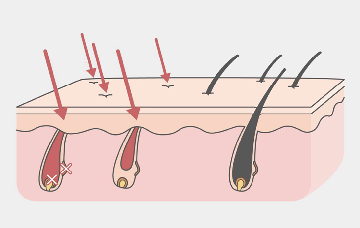海神除毛利用波長的組合解決了毛髮生長周期不同的除毛問題，調整脈衝時間和能量