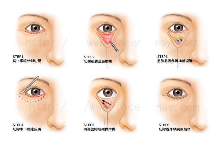 眼袋外開必須用切割方式來切除過多的眼皮，根據眉毛和睫毛間的距離，決定切除的多寡，同時調整眼睛的形狀。切割法能徹底矯症上述缺陷，同時雙眼皮能維持較久，缺點則是由於採開放式切割，可能會留下些許疤痕，恢復較慢。