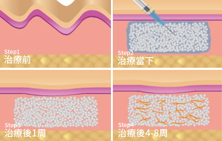 AestheFill球型結構會在治療後，立即提供澎潤效果，約1~3個月後，自體增生的膠原蛋白會再逐漸取代球型結構，讓困擾的凹陷改善，悄悄變美！周邊的人會疑惑，幾個月內好像越來越年輕