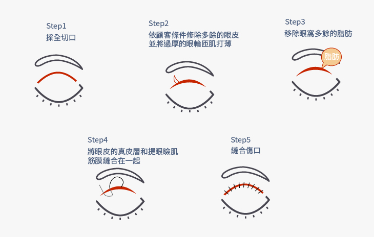 台中割雙眼皮過程,割雙眼皮恢復期多久_工作區域 1