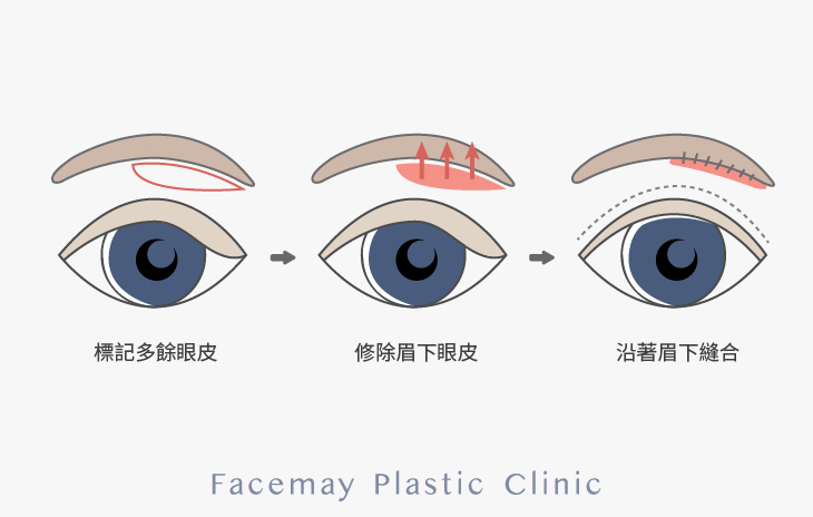 雙眼皮下垂不想拉皮還可以靠眉下拉皮來處理-01