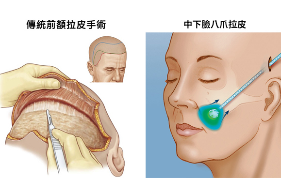 八爪拉皮乃以可吸收的乳酸及果酸聚合物（Polylactide）做成皮下固定釘，結構柔軟，可順應臉部的曲線來操作適用於曲線呈弧線的下半臉及下巴之皺紋改善，藉由固定釘勾住嘴邊或下巴餐肉向上提拉