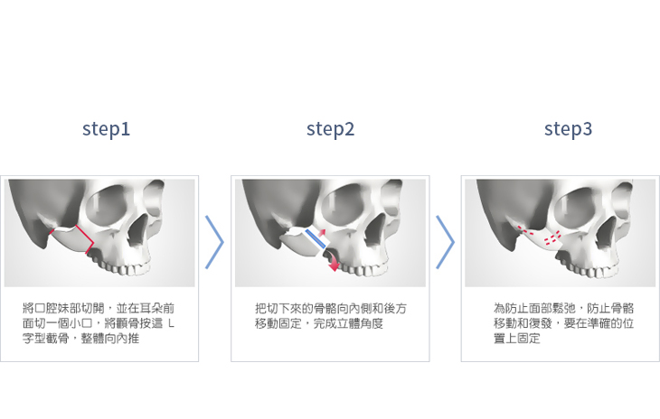 顴骨L型削骨適應對象,臉型平坦但後側顴骨弓突出而使臉變寬者