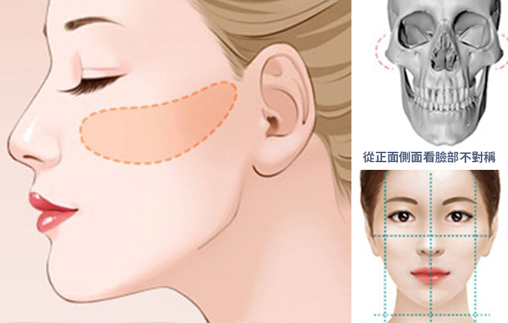 顴骨手術困難地方，是從口內的開口，要做到離較遠的眼眶骨外側，另外就是內推的角度及固定的方式，這幾年影像及定位系統的進步，讓這個手術變得更加精準。