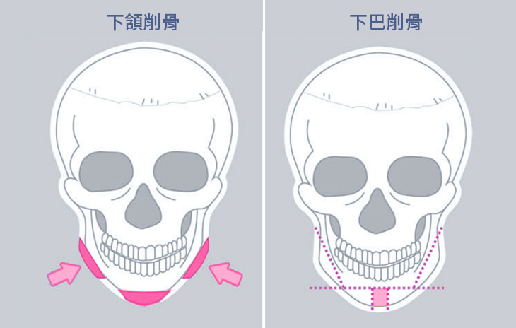 將過於寬厚的下巴以T型削骨、V型削骨或是側緣削骨，依照患者需求搭配並適當的進行截除與固定，打造出理想的臉型