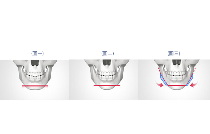 水平下巴截骨術適應對象-下巴寬-下巴過長-下頷骨角發達