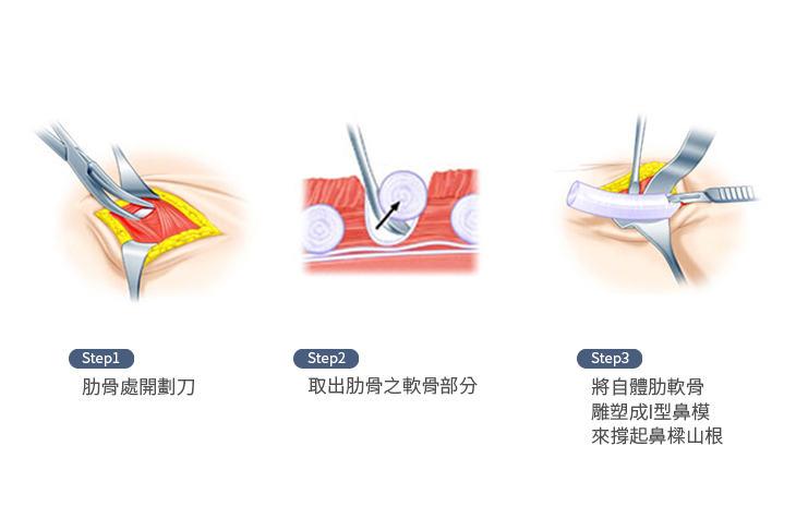 多次手術，種種原因導致鼻中隔軟骨缺損，更應該使用自體肋軟骨重建鼻中膈，同時完成鼻整形手術。另外唇裂鼻子，涉及複雜鼻部整形手術，也建議使用自體肋軟骨。感染性鼻子患者，擔心外來材料發生感染，唯一建議自體肋軟骨隆鼻。