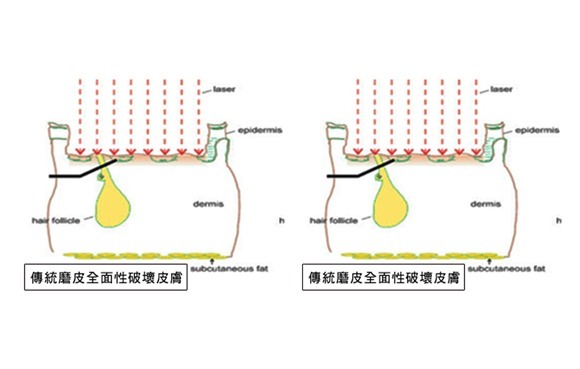 傳統脈衝光因波長單一,治療效果有限,會有突然過高的能量不均之情形,易造成燙傷、起水泡等熱傷害,或有「斑馬紋」情況產生 傳統脈衝光因波長單一,治療效果有限,會有突然過高的能量不均之情形,易造成燙傷、起水泡等熱傷害,或有「斑馬紋」情況產生