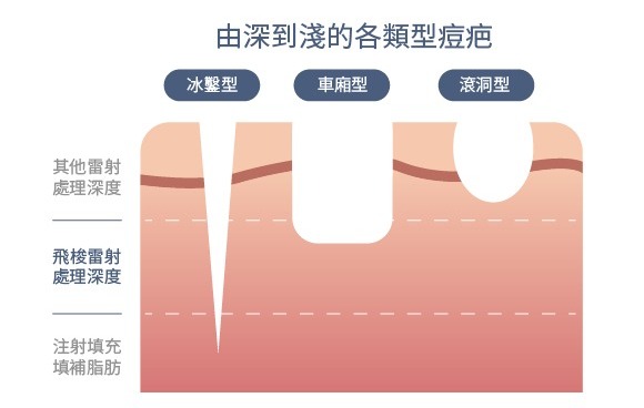 M22的7種不同波長的濾光片,依據膚色、年齡、個人需求來調整能量，解決各式酒糟肌膚、微細血管絲、泛紅肌,發炎性青春痘、痘疤色素沉澱，彩衝光比以往脈衝光更減少疼痛感，且更能增加治療效率。