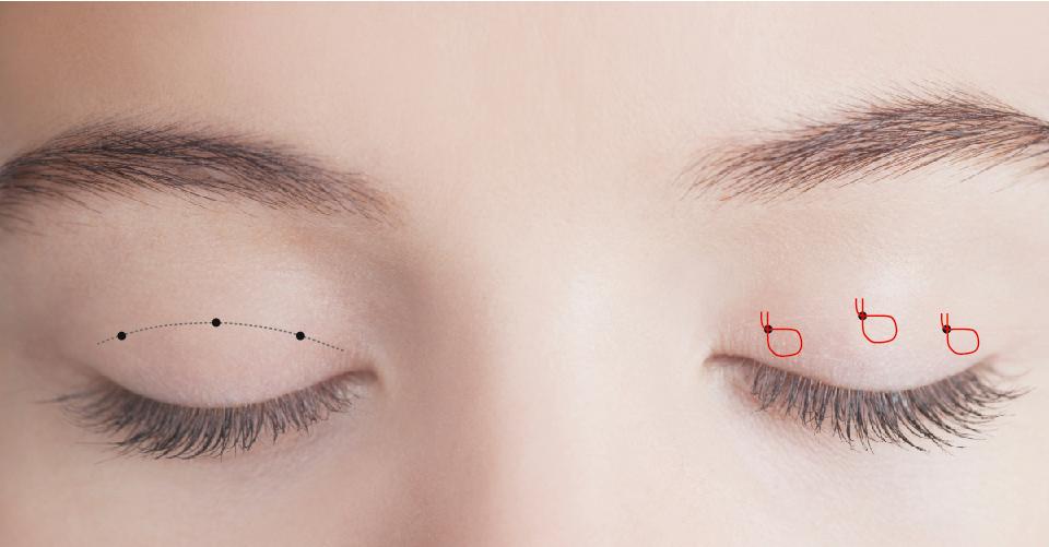 日式雙眼皮縫線