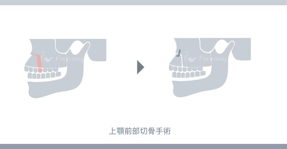 上顎前部切骨手術(Wassmund術式) 上顎前部切骨手術(Wassmund術式)