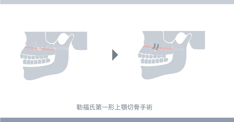 勒福氏第一形上顎切骨手術(LeFort I 術式) 勒福氏第一形上顎切骨手術(LeFort I 術式)