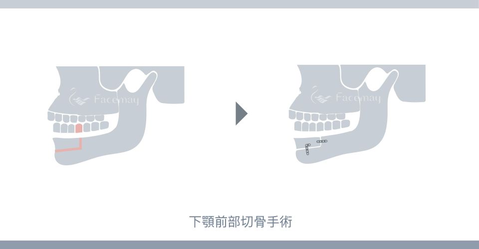 下顎前部切骨手術(Kole術式) 下顎前部切骨手術(Kole術式)
