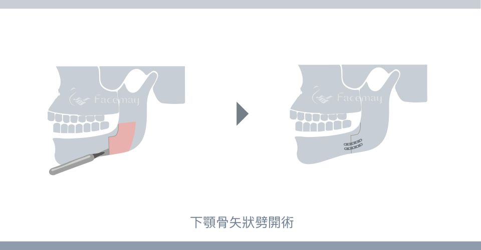 下顎骨矢狀劈開術(BSSO術式) 下顎骨矢狀劈開術(BSSO術式)