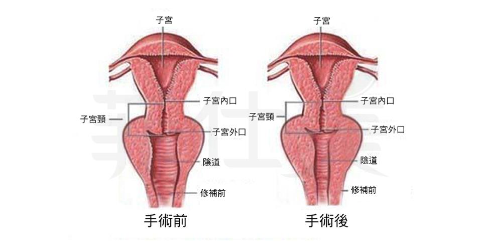 4D全層陰道緊縮手術示意圖