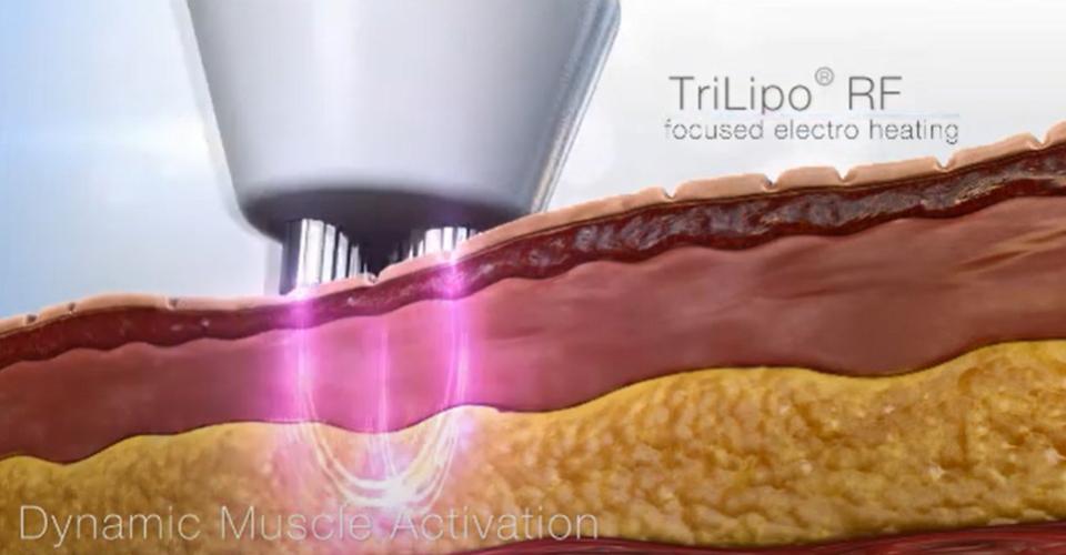 TriPollar 3D網狀環繞電波｜拉提UP
