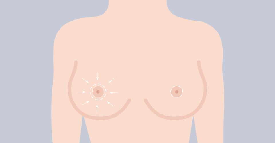 環狀切口（乳暈切口）平胸手術