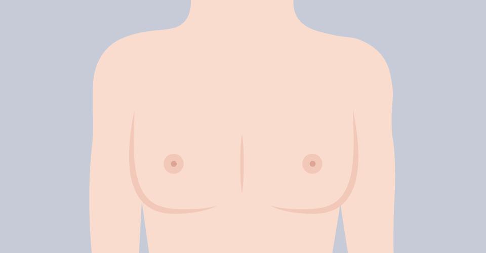 脂肪型胸部｜威塑抽脂