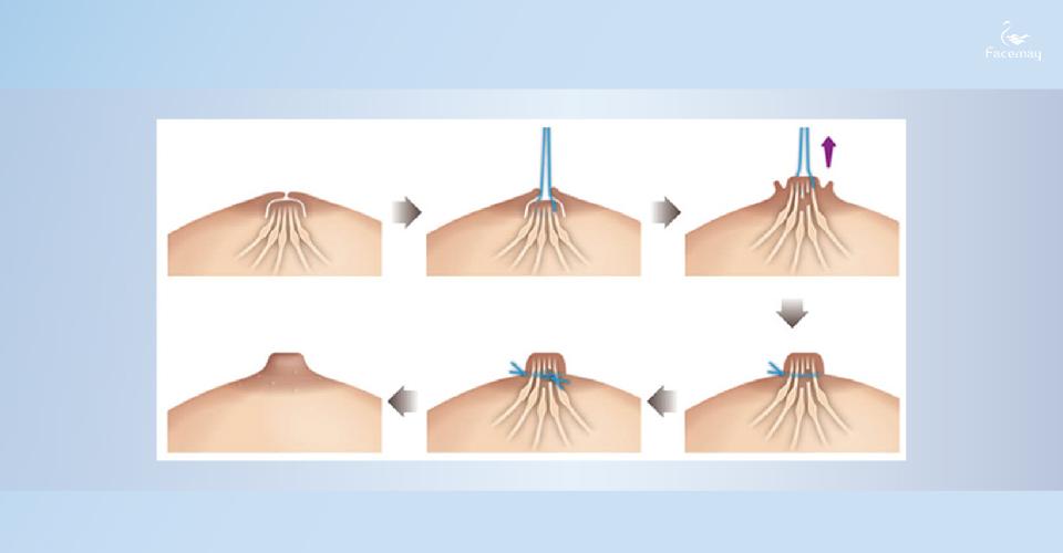 乳頭凹陷手術矯正