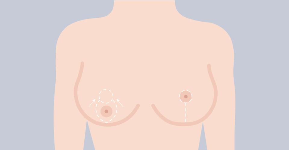 垂直切口（棒棒糖、雪人形狀切口）提乳縮乳手術