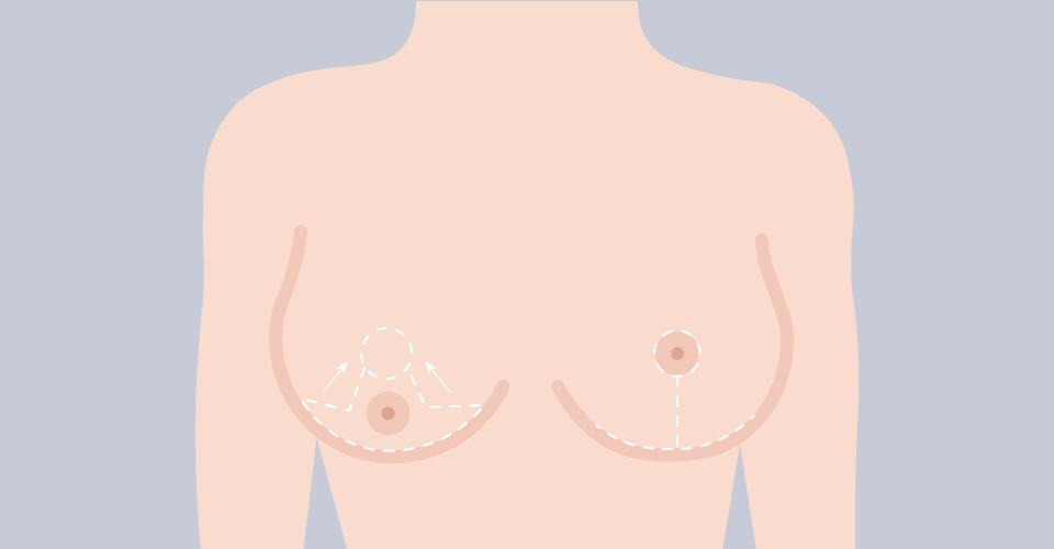 倒Ｔ字型（船錨狀切口）提乳縮乳手術
