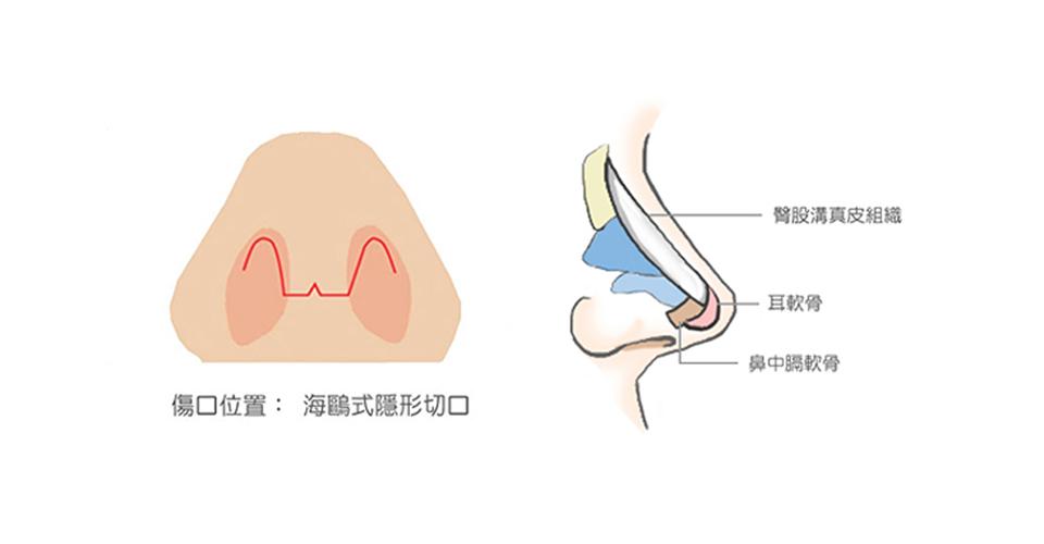 使用自體真皮組織